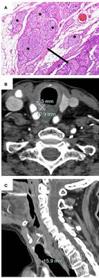 Denosumab for the Treatment of Hypercalcemia in a Patient With Parathyroid Carcinoma: A Case Report